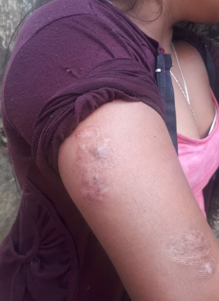 Lesión cutánea en el brazo asociada con la enfermedad transmitida por la mosca chiclera.