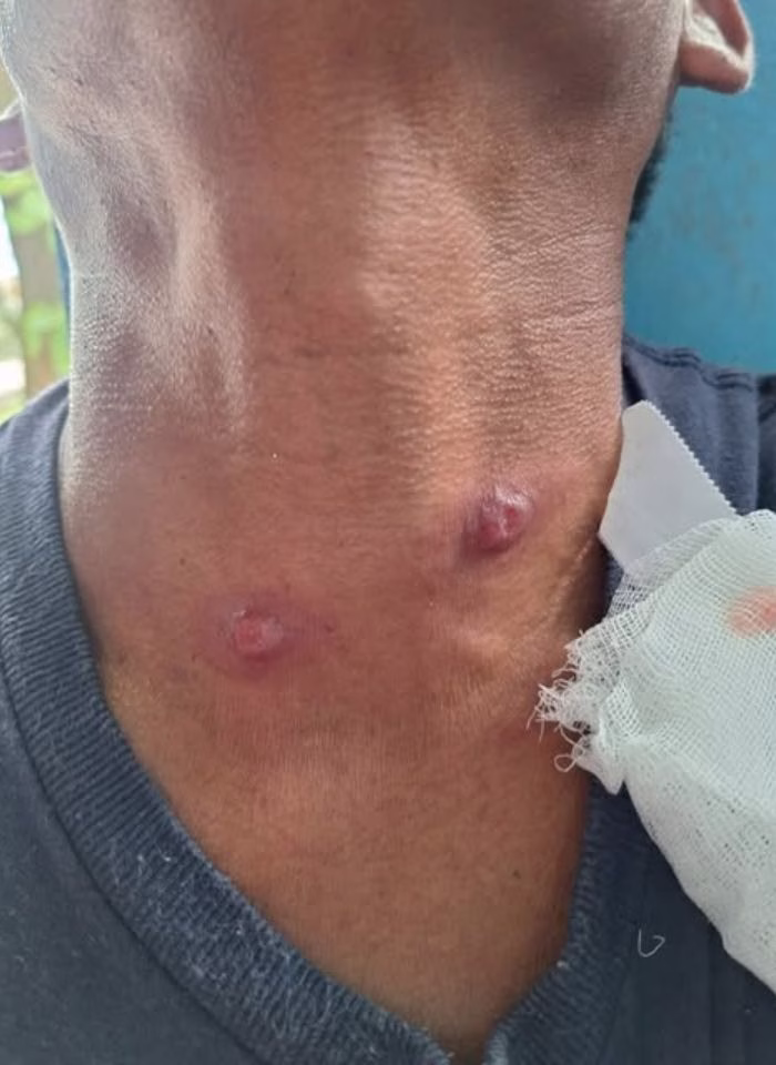 Lesiones cutáneas en el cuello de un paciente con la enfermedad de la mosca chiclera.