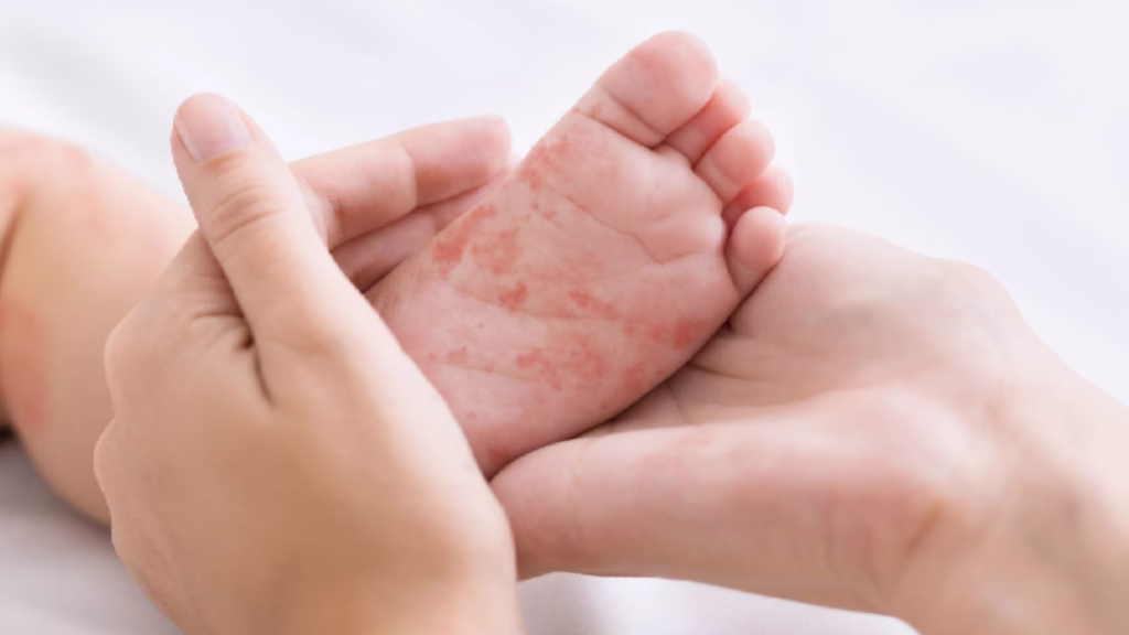 El sarampión mantiene vigilancia epidemiológica en Quintana Roo durante 2026.
