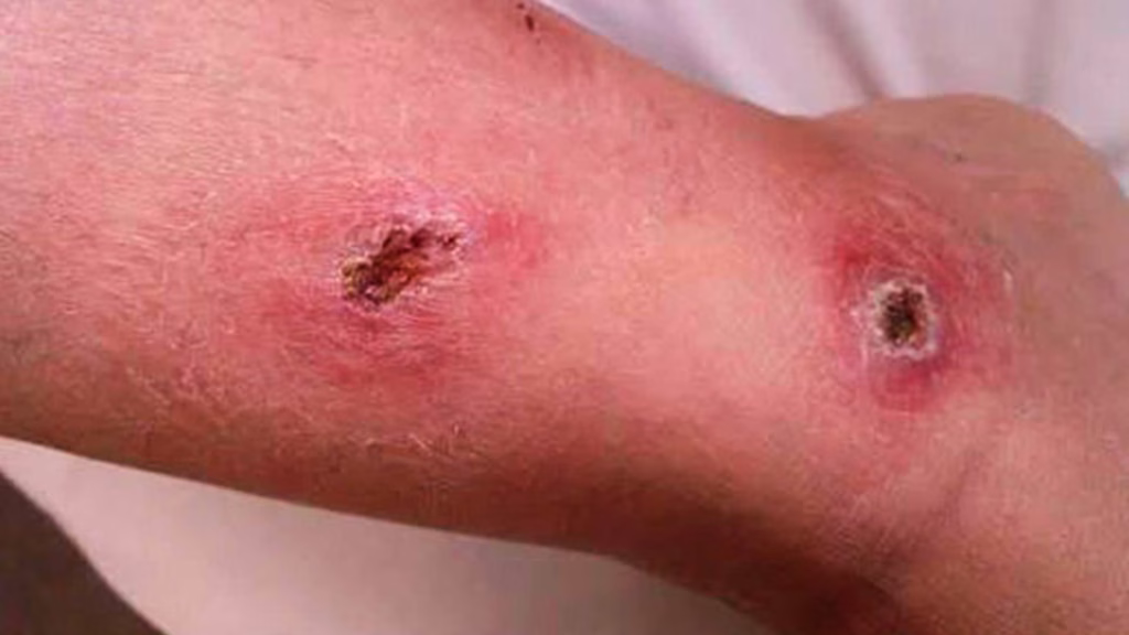 Las lesiones provocadas por la leishmaniasis pueden evolucionar a úlceras si no reciben atención médica.